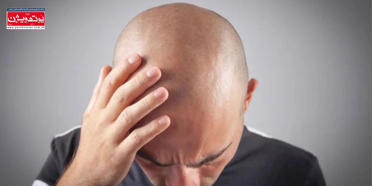 مردانہ گنج پن کی نمایا تصؤیر۔۔